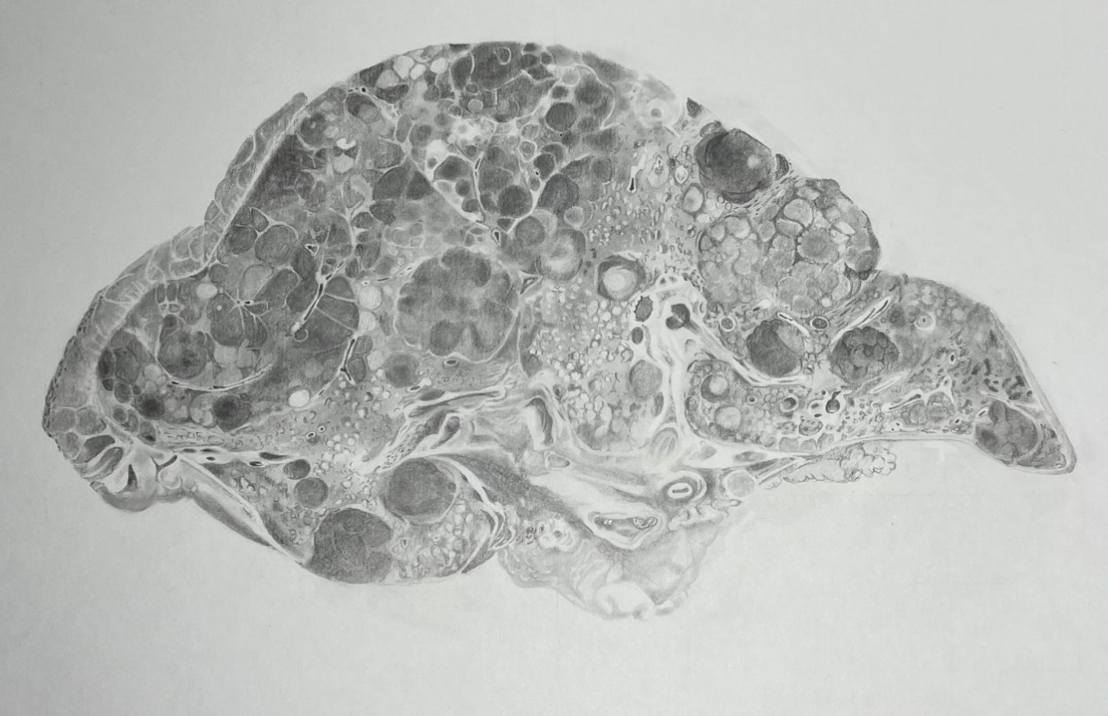 LIVER Hepatocellular carcinoma-1